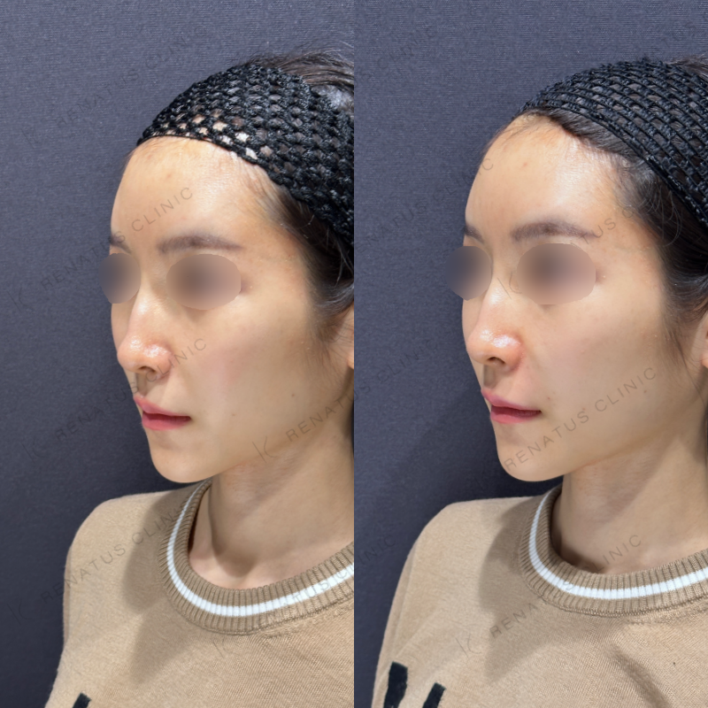 ほうれい線ヒアルロン酸ボリフト症例写真