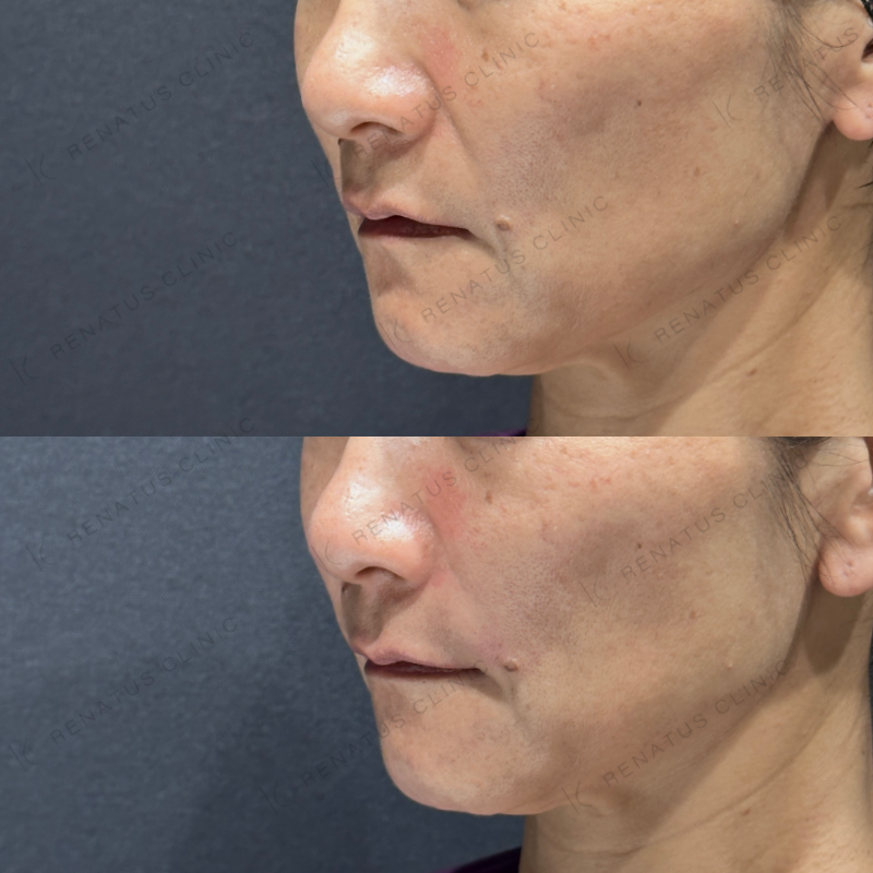 ほうれい線ヒアルロン酸ボリフト症例写真