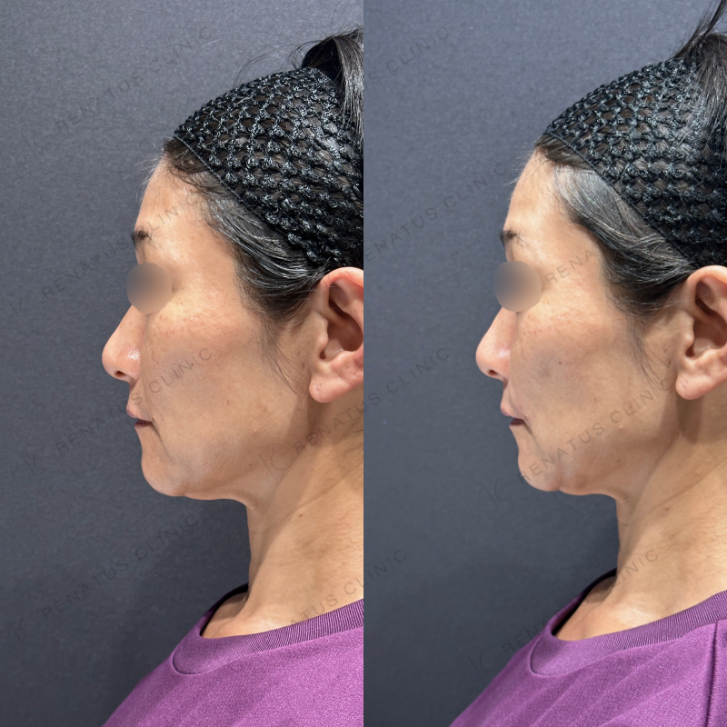 ほうれい線ヒアルロン酸ボリフト症例写真