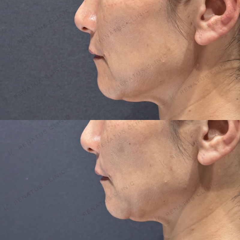 ほうれい線ヒアルロン酸ボリフト症例写真