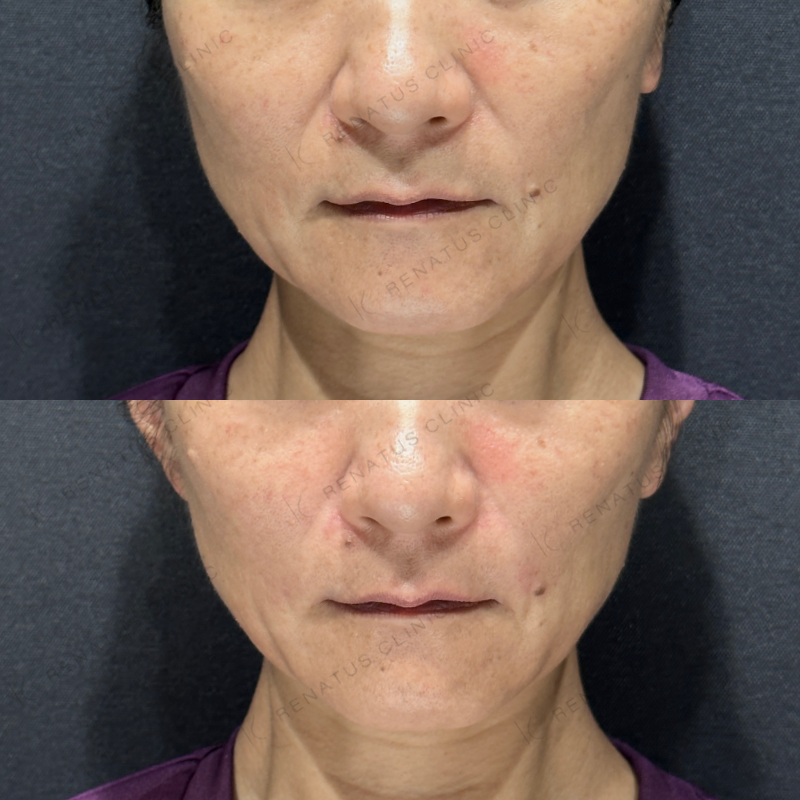 ほうれい線ヒアルロン酸ボリフト症例写真