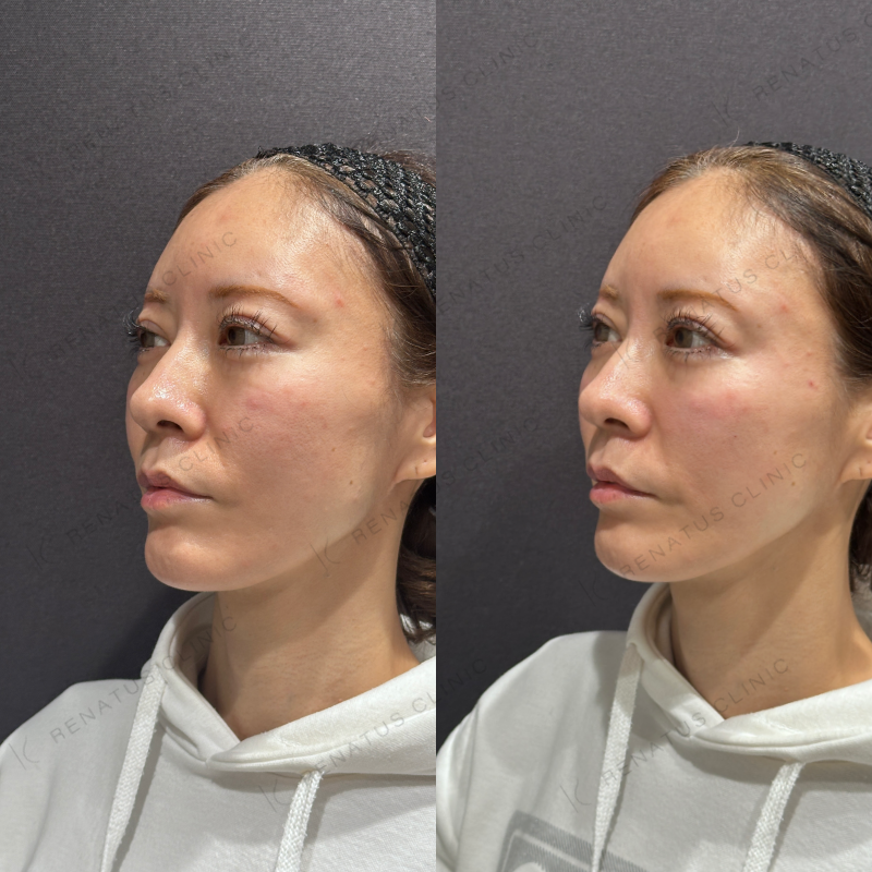 こめかみ・頬ヒアルロン酸ボライト症例写真
