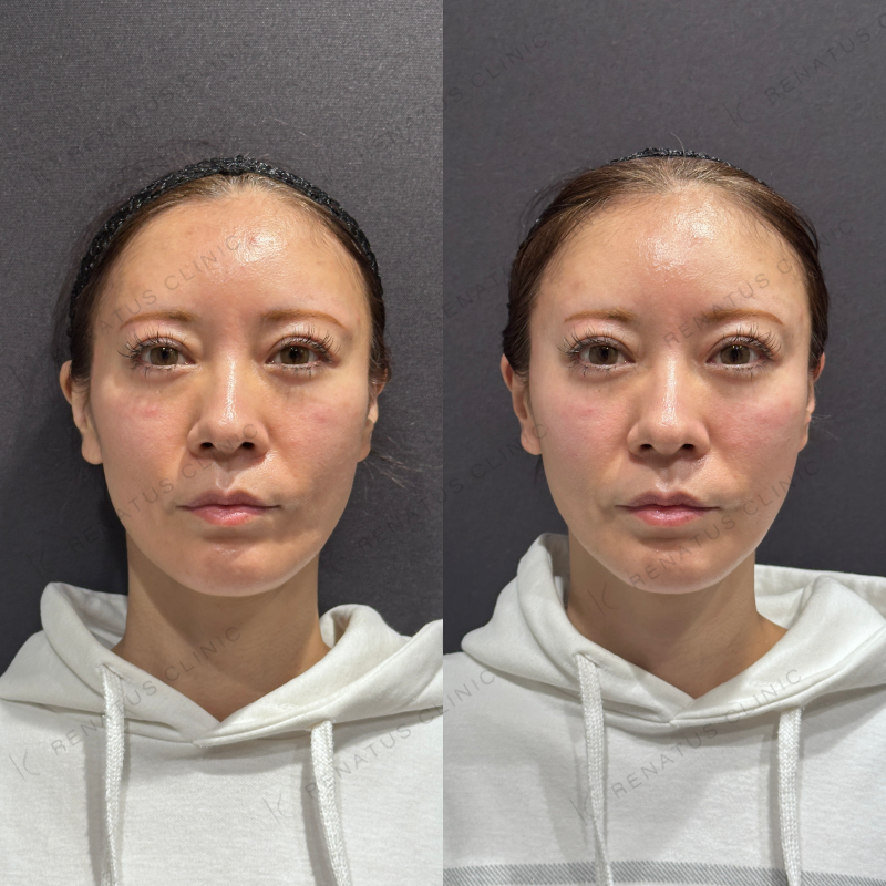 こめかみ・頬ヒアルロン酸ボライト症例写真