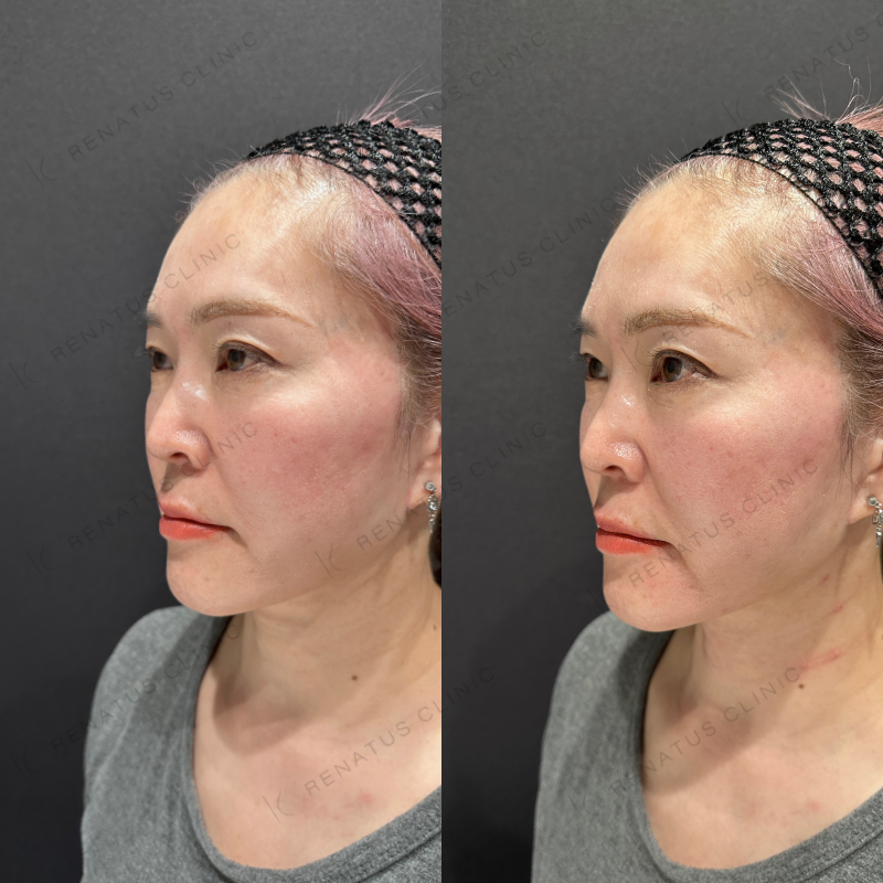 マリオネットヒアルロン酸ボリフト症例写真