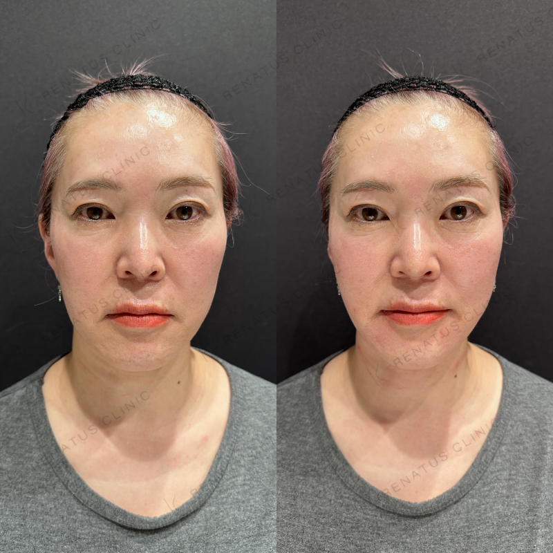 マリオネットヒアルロン酸ボリフト症例写真