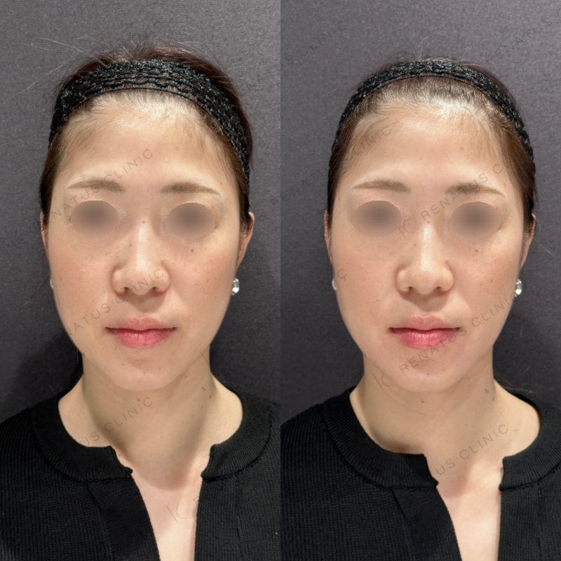 マリオネットヒアルロン酸ボリフト症例写真