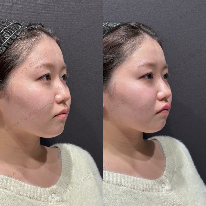 唇ヒアルロン酸ボルベラ症例写真