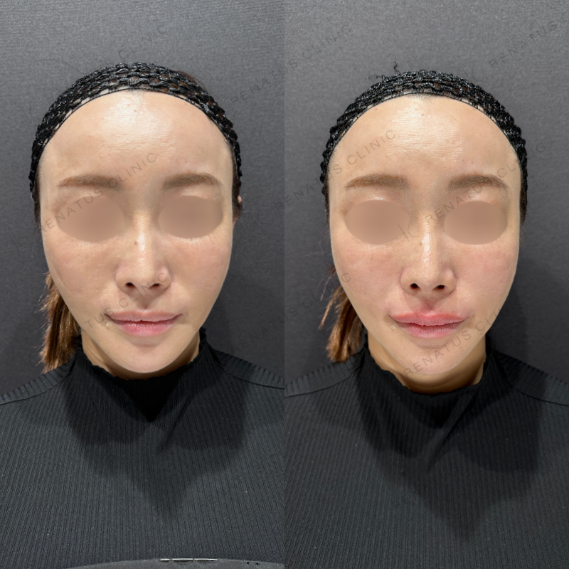 唇ヒアルロン酸ボルベラ症例写真