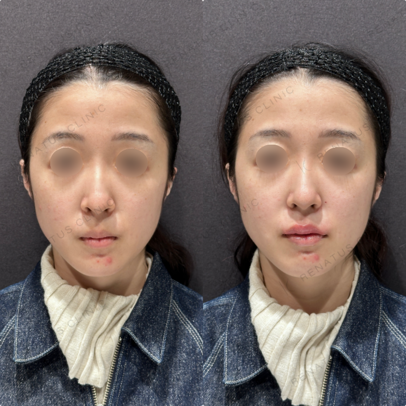 唇ヒアルロン酸ボルベラ症例写真