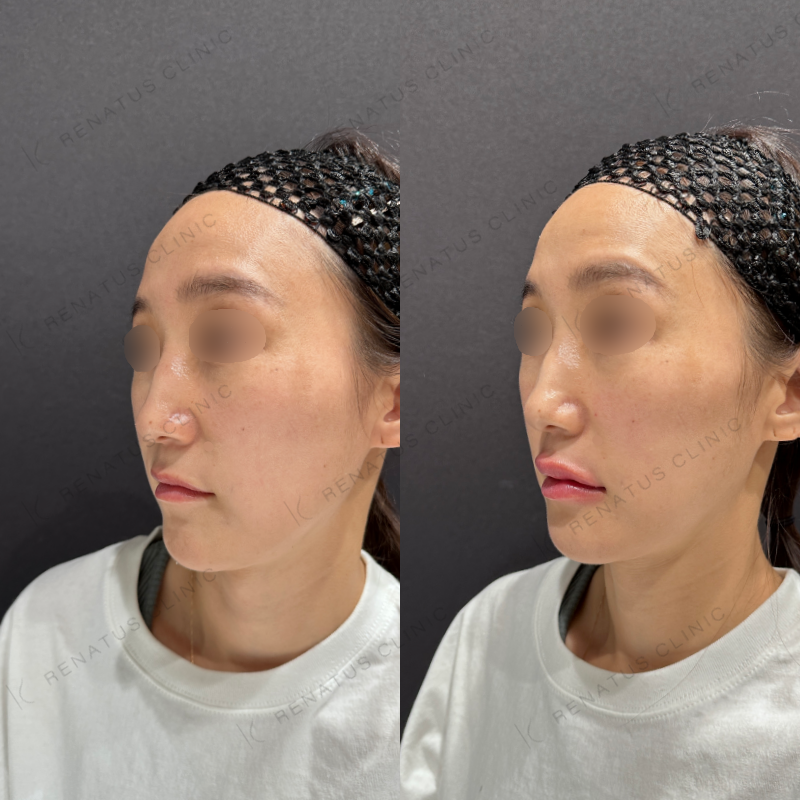 唇ヒアルロン酸ボルベラ症例写真