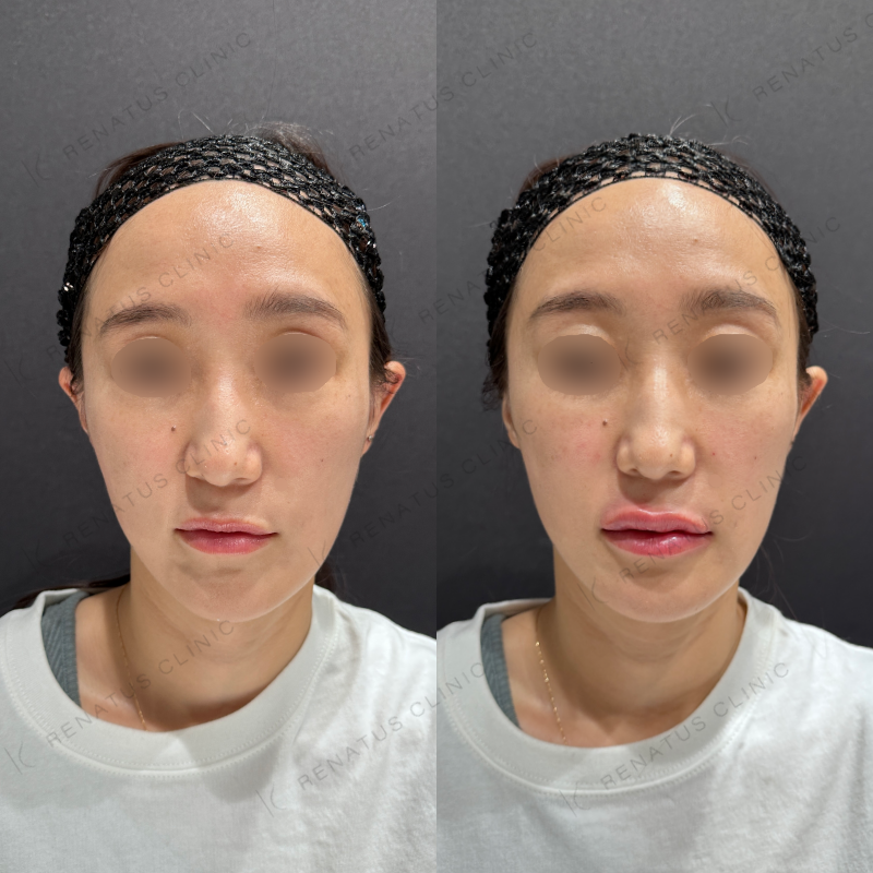 唇ヒアルロン酸ボルベラ症例写真