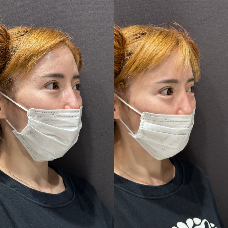 涙袋ヒアルロン酸ボリフト症例写真