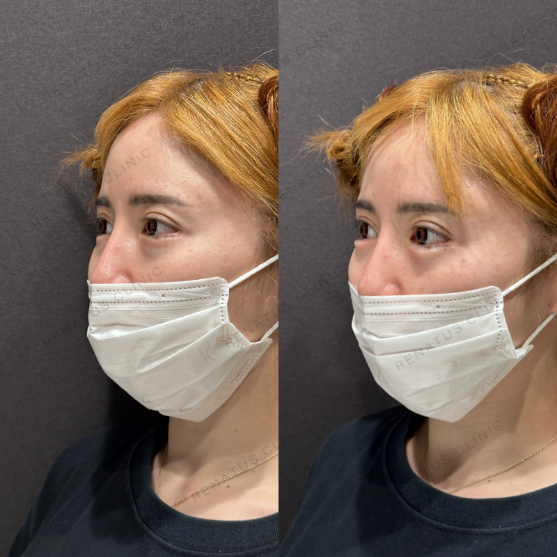 涙袋ヒアルロン酸ボリフト症例写真