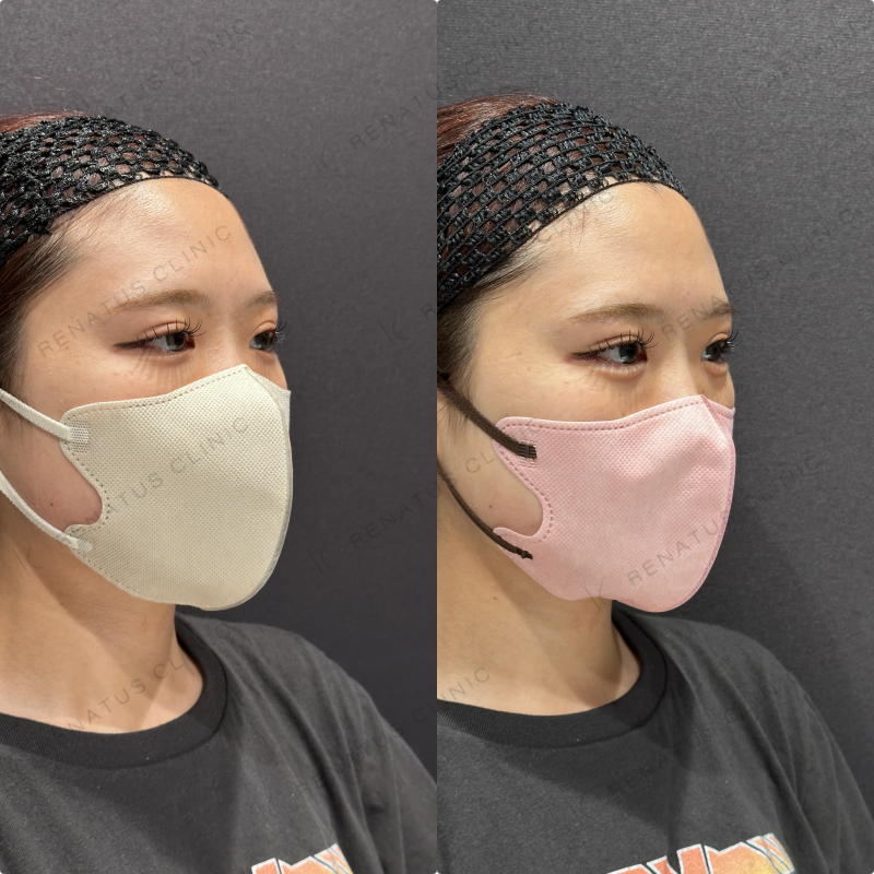 涙袋ヒアルロン酸ボルベラ症例写真