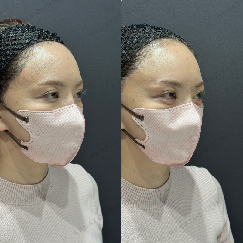 涙袋ヒアルロン酸ボルベラ症例写真