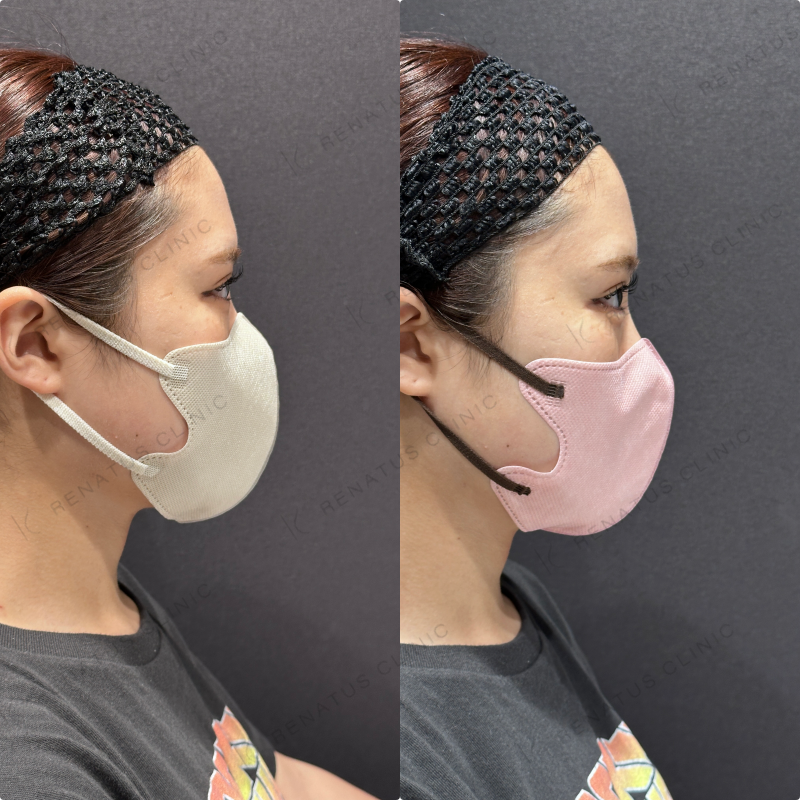 涙袋ヒアルロン酸ボルベラ症例写真