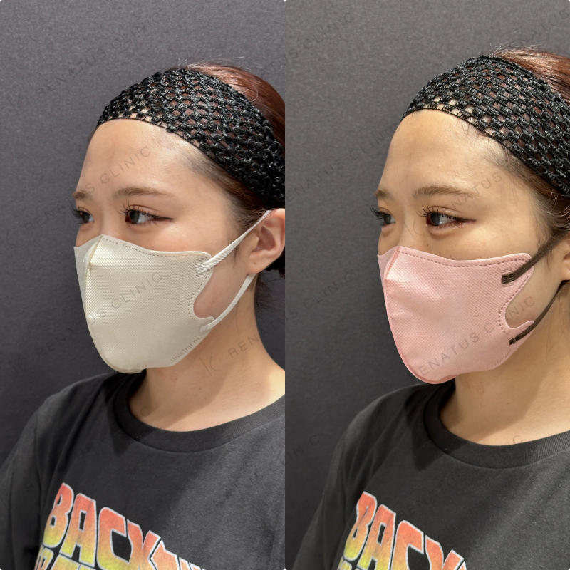 涙袋ヒアルロン酸ボルベラ症例写真
