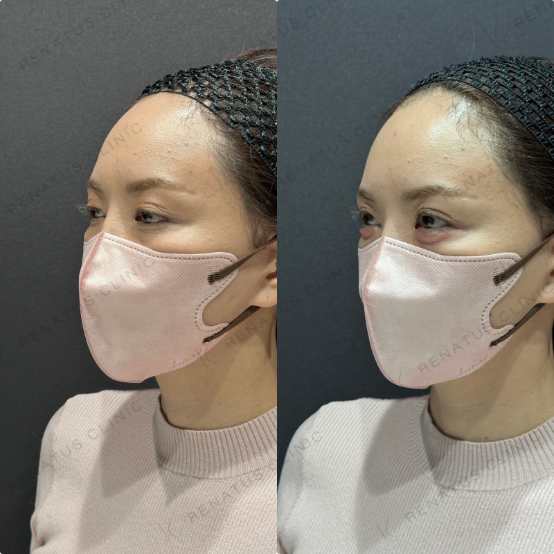 涙袋ヒアルロン酸ボルベラ症例写真
