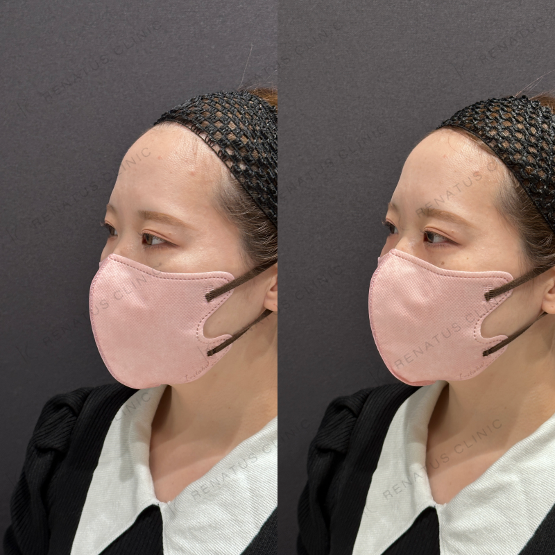 涙袋ヒアルロン酸ボルベラ症例写真