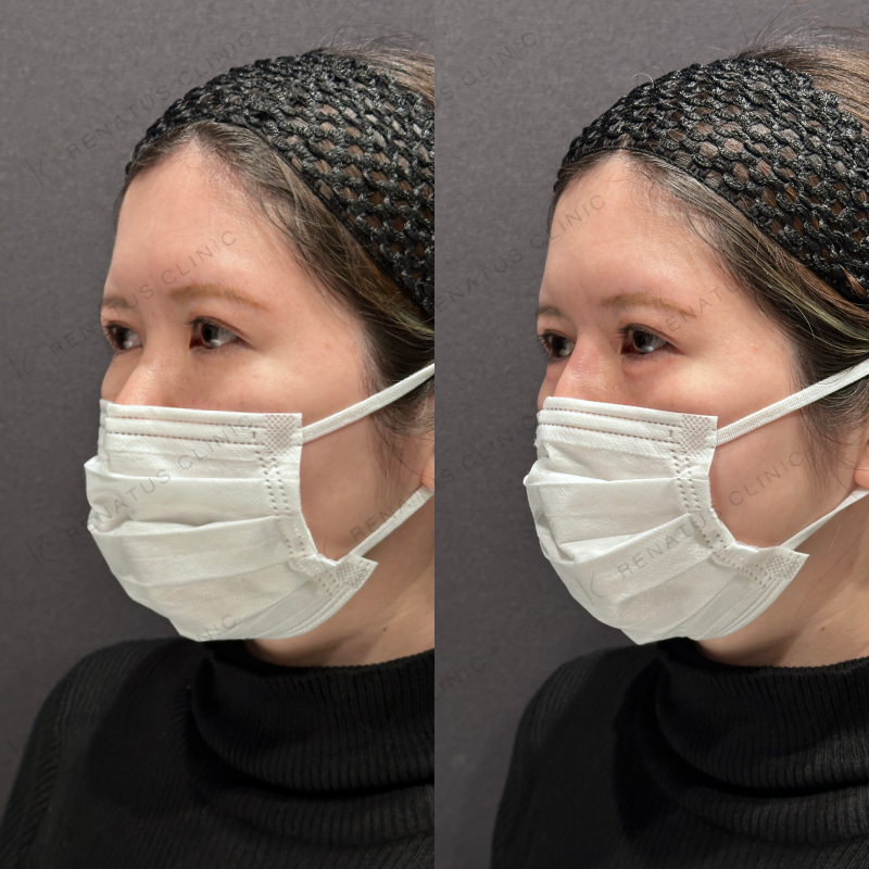 涙袋ヒアルロン酸ボルベラ症例写真