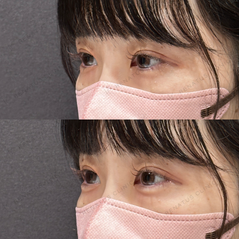 涙袋ヒアルロン酸ボルベラ症例写真