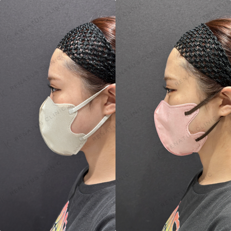 涙袋ヒアルロン酸ボルベラ症例写真