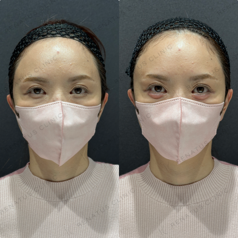 涙袋ヒアルロン酸ボルベラ症例写真