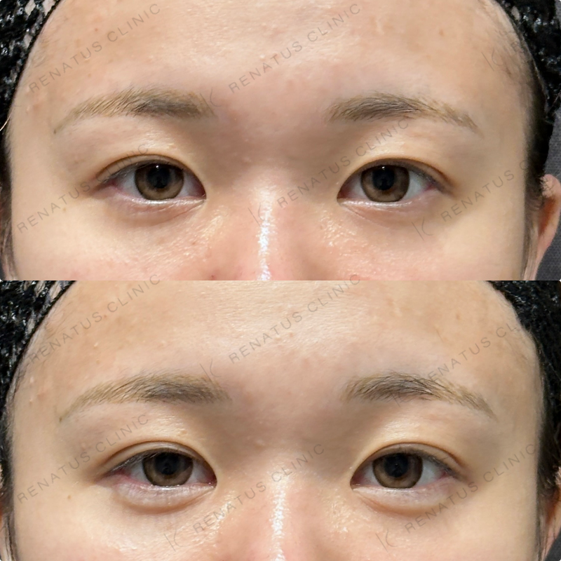 涙袋ヒアルロン酸ボルベラ症例写真