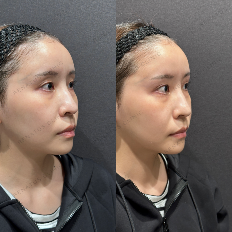 目の上ヒアルロン酸ボライト症例写真
