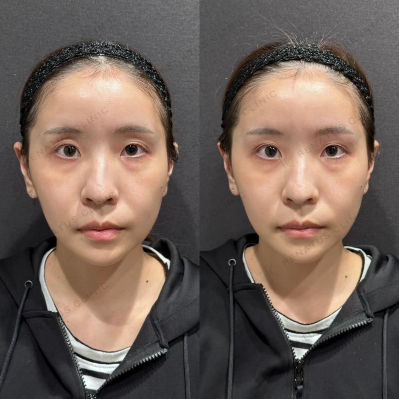 目の上ヒアルロン酸ボライト症例写真