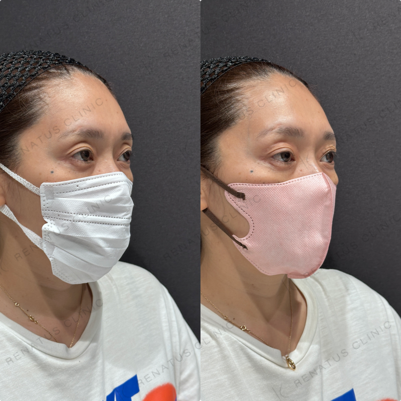 目の上ヒアルロン酸ボルベラ症例写真