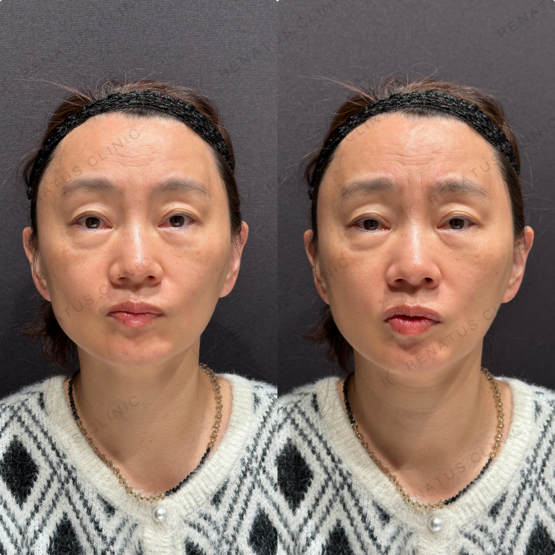 目の上ヒアルロン酸ボルベラ症例写真