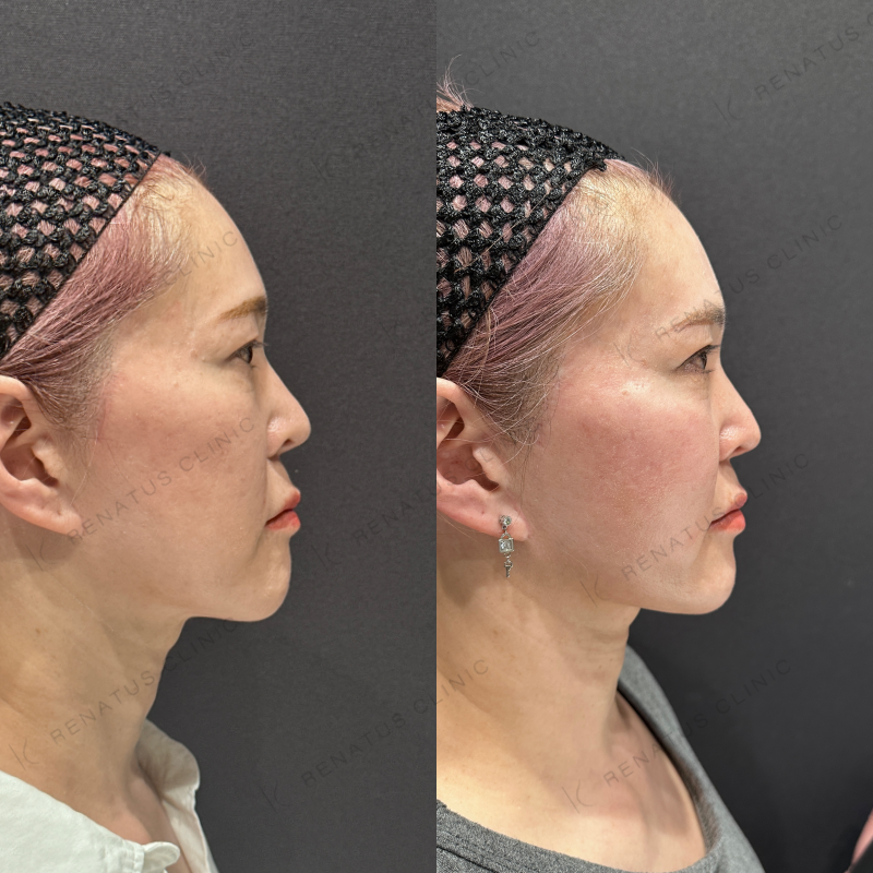 頬ヒアルロン酸ボライト症例写真
