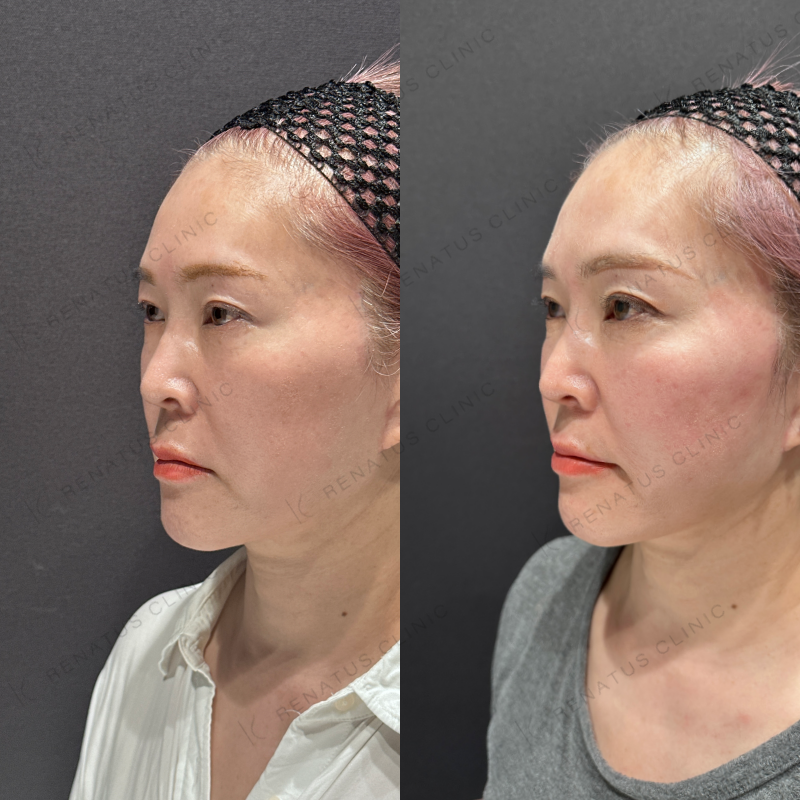 頬ヒアルロン酸ボライト症例写真