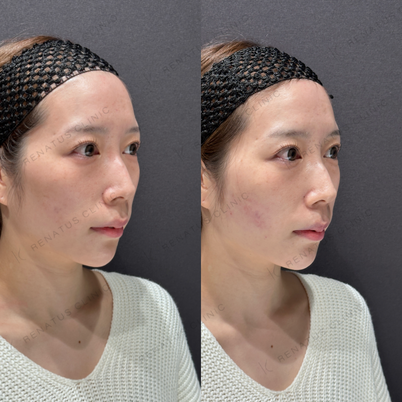 頬ヒアルロン酸ボリフト症例写真
