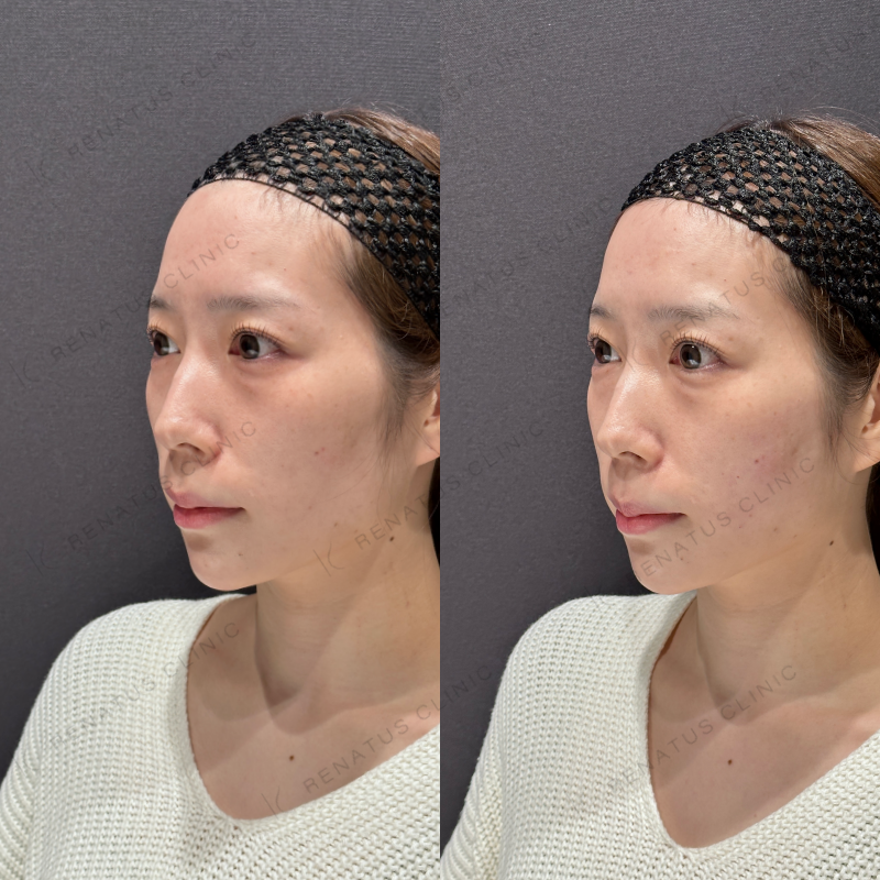 頬ヒアルロン酸ボリフト症例写真