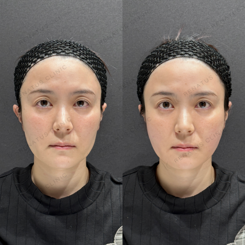 頬ヒアルロン酸ボリフト症例写真