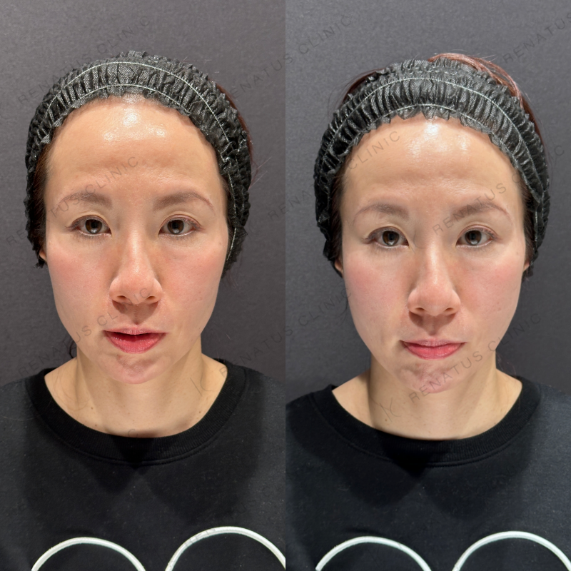 頬こけヒアルロン酸ボリフト症例写真