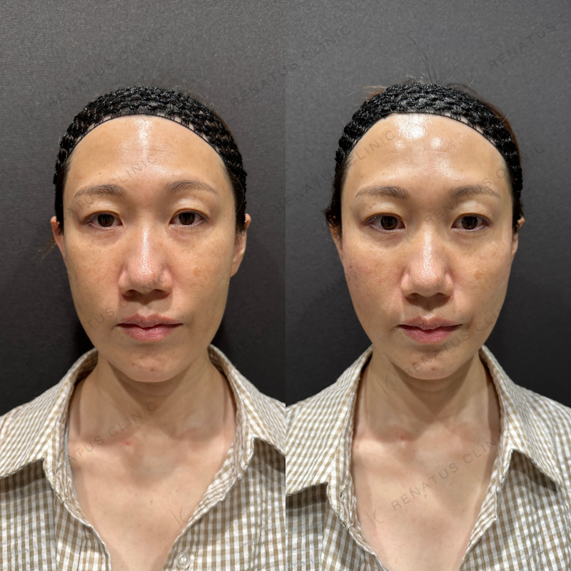 頬コケヒアルロン酸ボリフト症例写真