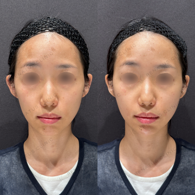 頬コケ・顎ヒアルロン酸ボリフト・ボラックス症例写真