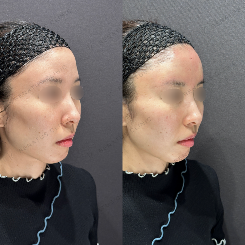 額ヒアルロン酸ボリューマ症例写真
