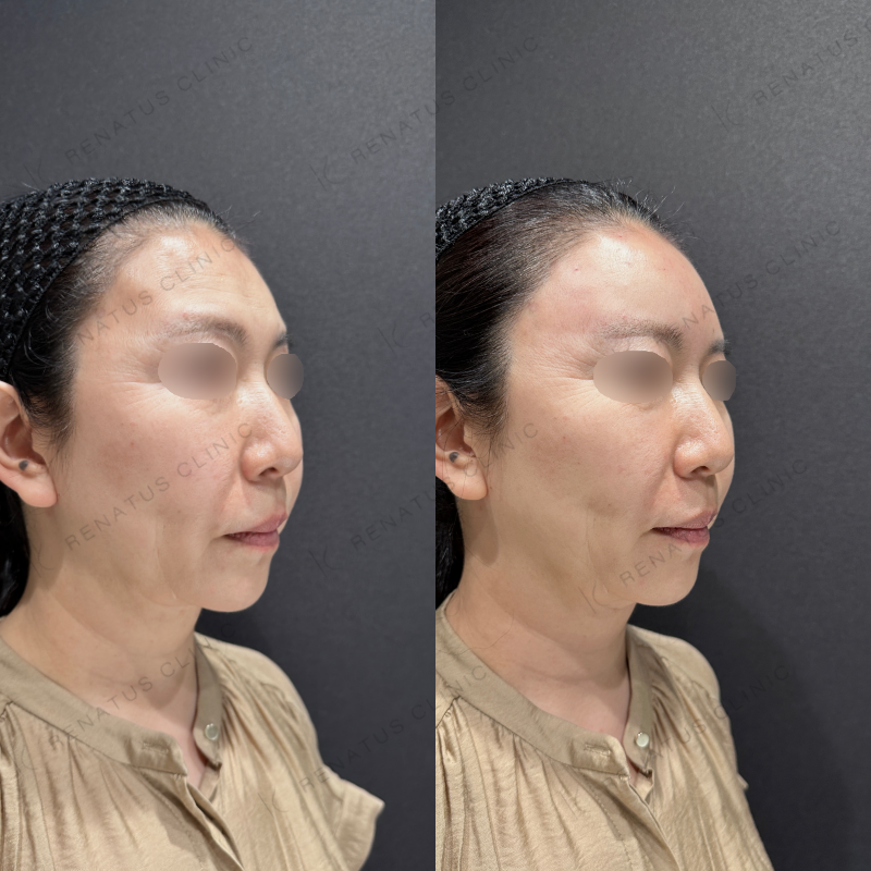 額・こめかみヒアルロン酸ボリューマ症例写真