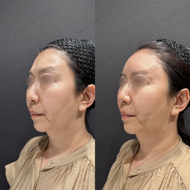 額・こめかみヒアルロン酸ボリューマ症例写真