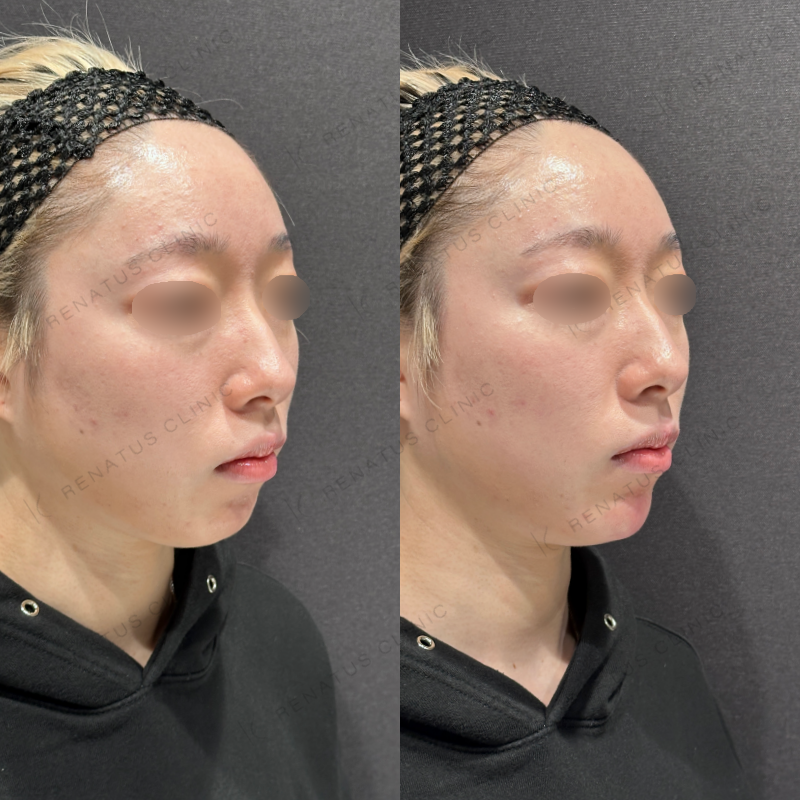 顎ヒアルロン酸ボラックス症例写真