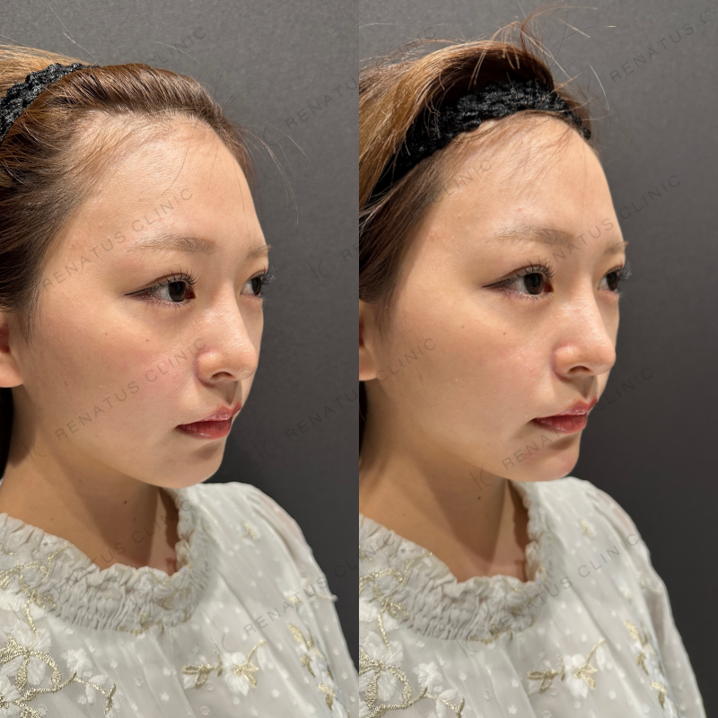 顎ヒアルロン酸ボラックス症例写真