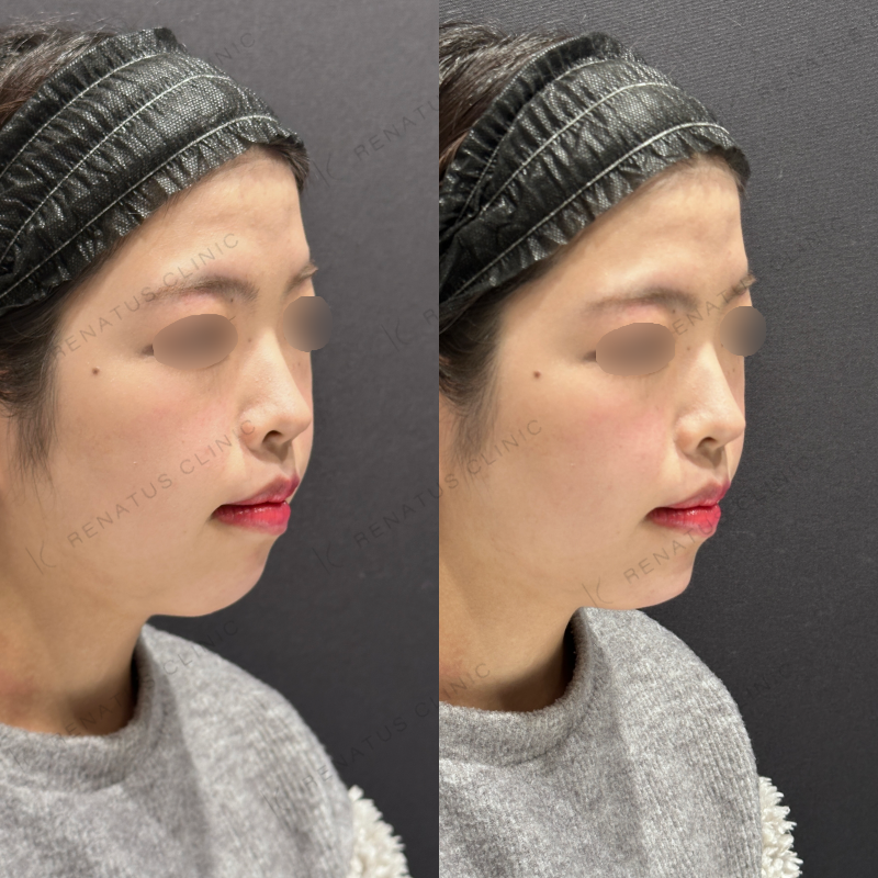 顎ヒアルロン酸ボラックス症例写真