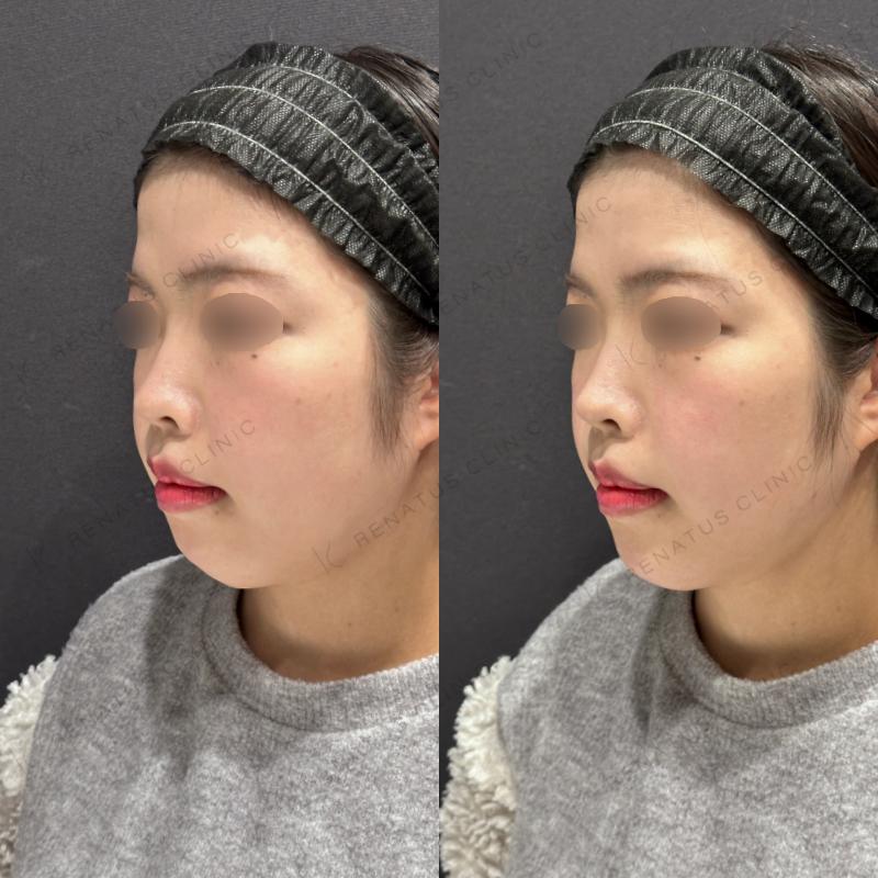 顎ヒアルロン酸ボラックス症例写真