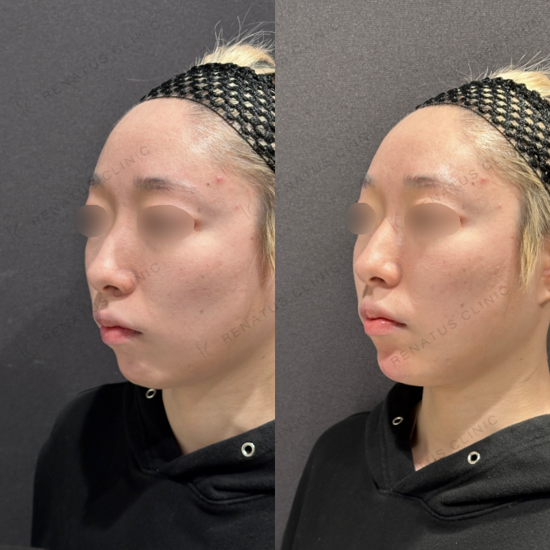 顎ヒアルロン酸ボラックス症例写真