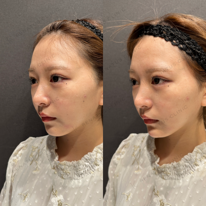 顎ヒアルロン酸ボラックス症例写真