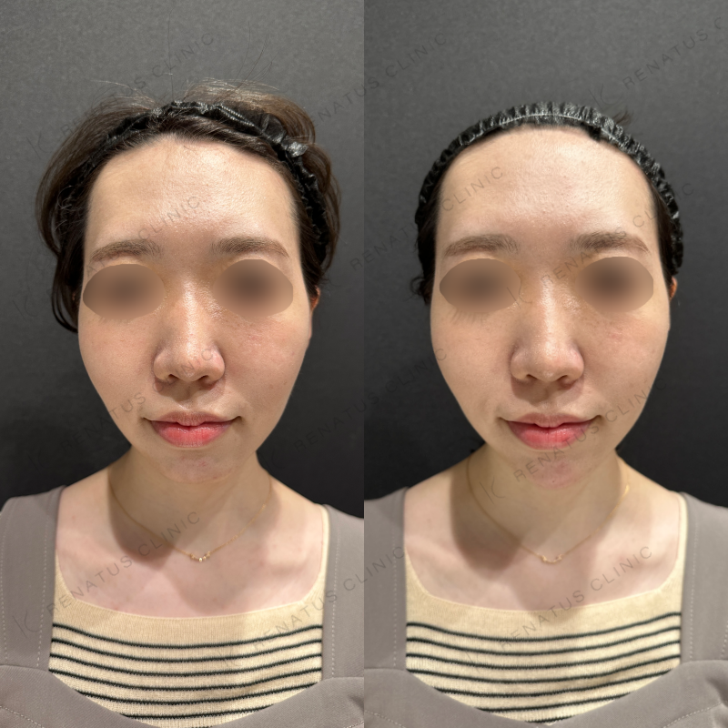 顎ヒアルロン酸ボラックス症例写真